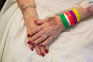 Older lady bruised hands, Nursing Home Abuse Lawyer Washington IL